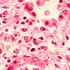 A Clallam County woman is said to be the first to die from the measles in the U.S. since 2003