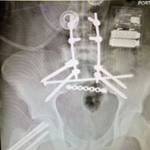 After falling from a bridge on accident, Luke Silliman is receiving treatment at Northwestern Memorial Hospital in Chicago where he&rsquo;s had two surgeries including 12 screws, two rods and a titanium plate placed into his body. Submitted photo