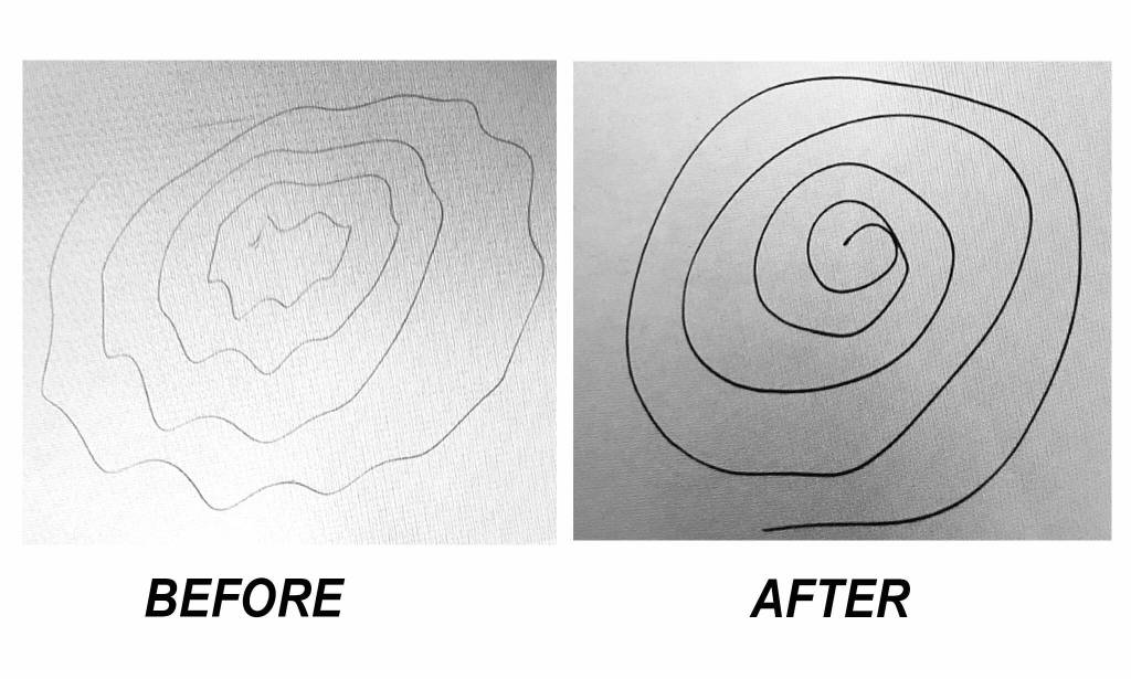 For Deep Brain Stimulation (DBS), patients like Cathie Osborne are asked to draw a spiral and medical staff adjust the low-intensity electrical impulses to nerves to better control tremors for patients with essential tremor and Parkinsons disease. Photos courtesy of Cathie Osborne