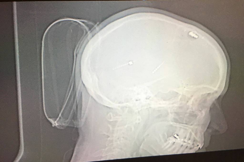 To control and limit tremors on her right side, Cathie Osborne said a neurosurgeon at Swedish installed a neurostimulator in her skull with a wire to a generator/battery about the size of her palm placed inside her chest just below her left collarbone. Now she is able to have it calibrated remotely through Zoom calls with her doctor every few months as needed. Photo courtesy of Cathie Osborne