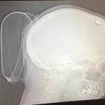 To control and limit tremors on her right side, Cathie Osborne said a neurosurgeon at Swedish installed a neurostimulator in her skull with a wire to a generator/battery about the size of her palm placed inside her chest just below her left collarbone. Now she is able to have it calibrated remotely through Zoom calls with her doctor every few months as needed. Photo courtesy of Cathie Osborne